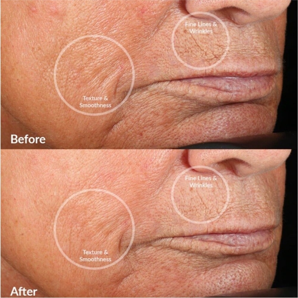 PMD Personal Microderm Device - Picture 10 of 10